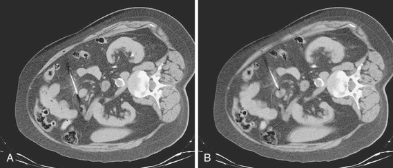 FIG 67-24, A, Small lesions in deep locations can be sampled using only CT. Scan shows a tiny mass in the root of the mesentery. This first pass shows the needle deflecting past the mass. The patient was positioned obliquely, which permitted the bowel to float away slightly, clearing a pathway for the needle. B, Repositioning of the needle and using the bevel of the needle to prevent deflection, the mass was sampled adequately. See discussion under “ Intentional Organ Movement or Tissue Retraction .”