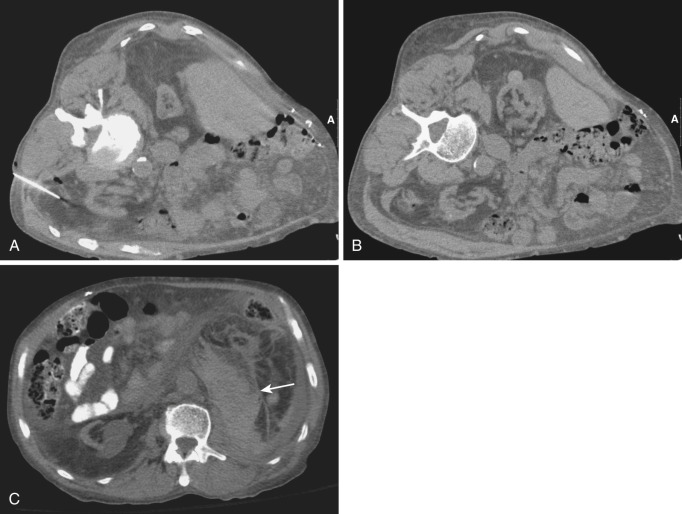 FIG 67-27, A, FNA biopsy of small retroperitoneal nodule. B, After biopsy, minimal stranding is noted but no significant hemorrhage. C, After several minutes the patient complained of pain, and a repeat scan was performed. The scan shows substantial hematoma (arrow) that is high density from clot formation. The bleeding was self-limited, and no transfusion was required.