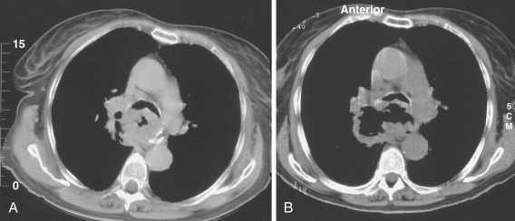 FIG 67-28, A, Scan shows thickening of the gastric pull through the segment, believed to represent tumor. Based on this study, I scheduled the patient for a biopsy procedure. B, Repeat scan on the day of the procedure shows a normal-appearing stomach, so the procedure was canceled. There was no skin preparation or local anesthetic. The patient was admitted to a local hospital the next day with life-threatening hemoptysis. She ultimately died as a result of bleeding.