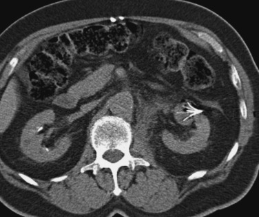 FIG 67-5, RFA of kidney tumor shows the high-density probe with individual tines clearly visible. Small gas bubbles are present in the tumor site from the heating effects. Such bubbles are not visible on MRI or US (see text).