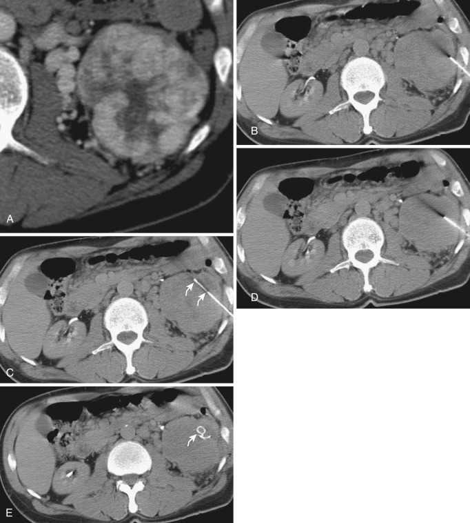 FIG 67-33, A, Preplanned placement of hemostatic coil should be performed if intense vascular enhancement is shown on a dynamic contrast bolus scan. The left kidney shows increased enhancement of renal tumor and large collateral vessels in the retroperitoneum. B, A coaxial cannula is positioned adjacent to the target in the anterior margin of kidney. C, CT scan shows the stylet extending beyond the end of the cannula (arrows). D, After biopsy, the biopsy needle is removed, leaving the cannula in place for the hemostatic procedure. E, The angiographic coil soaked with thrombin is pushed into the site by the angiographic wire (thrombin is not injected but rather is on the coil; see Fig. 67-32 ). The coil remains precisely at the site of the biopsy (arrow).