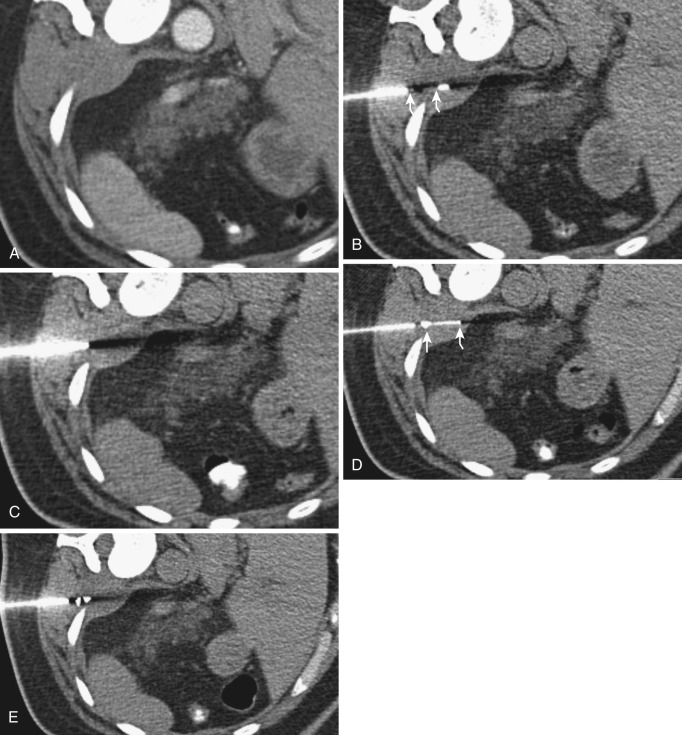 FIG 67-34, A, Emergent insertion of hemostatic coil. CT scan shows a soft tissue mass in the posterior abdominal wall. B, Coaxial needle biopsy of the mass. Note the stylet extending beyond the cannula (arrows). C, Note the cannula remaining at the site after the needle removal. Rapid bleeding occurred backward through the cannula. The stylet was replaced. Preparations for hemostatic coil were made as noted in Figure 67-32 . D, Thrombin-soaked coil is pushed through the cannula, depositing it in the biopsy site (arrows). E, Two coils were inserted beyond the tip of the cannula. Hemostasis was accomplished, and the cannula was withdrawn.