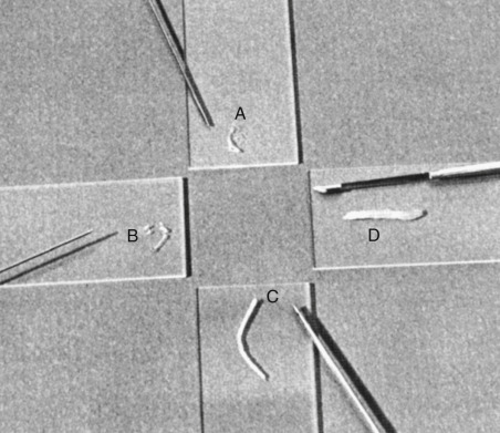 FIG 67-36, The type and relative size of specimens obtained with four different needles. Specimen A was obtained with three passes of the 22-gauge skinny core needle using 30 mL of suction and a 2-cm insertion of the needle. Specimen B was obtained in one pass of an 18-gauge bevel-end needle using 30 mL of suction and a 2-cm insertion of the needle. Specimen C was obtained with an 18-gauge Menghini needle using 30 mL of suction and a 2-cm insertion of the needle. Specimen D was obtained with the Tru-Cut needle and no suction.