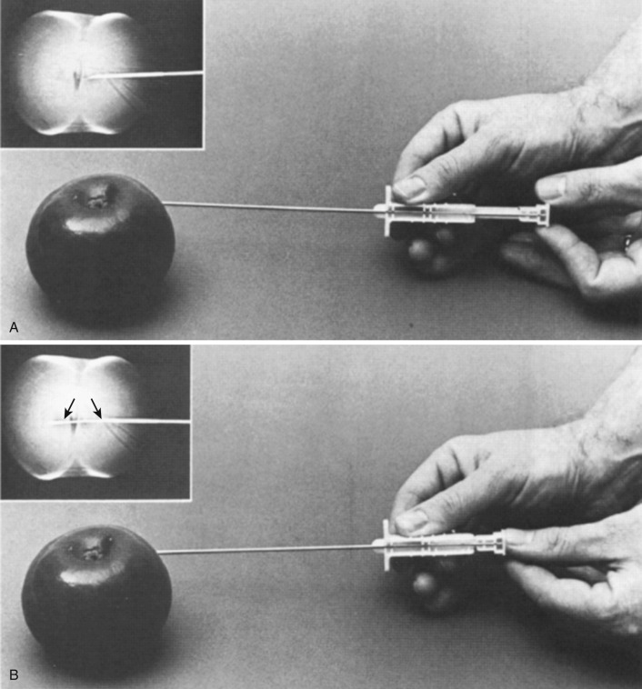 FIG 67-37, Core biopsy of an apple using the Tru-Cut needle. A, Insert the needle in the closed position to the margin of the lesion. B, Insert the inner stylet with the “gap” (arrows) briskly through the area of the lesion. (If the needle is improperly positioned, it can be withdrawn in this position; a specimen would not be cut unless the outer needle is advanced over the gap.) C, With the inner stylet (arrow) held stationary, advance the outer needle rapidly over the gap. (The outer needle cuts the specimen into the gap.) D, A hard material such as bone (in this case, an apple seed) can deflect the thin portion of the needle. This has never been a problem with soft tissue tumors, but the Tru-Cut needle is unsuitable for lesions in or against bone for this reason.