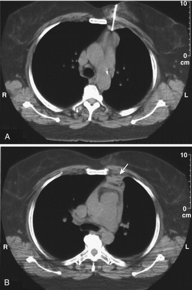FIG 67-38, Patient at another institution who had biopsy by single-action needle and died as a result of biopsy of the main pulmonary artery and subsequent bleeding (we testified in the lawsuit). A, Preliminary localization with a single-action cutting needle shows proper positioning of the needle in front of the mass. B, CT scan after the biopsy shows hematoma in front of the main pulmonary artery (arrow) after the biopsy. Because the patient moved slightly during the procedure, the internal anatomy shifted slightly so that when the single-action needle was fired, it cut the main pulmonary artery, resulting in hemopericardium and death. With the single-action needle, the site of the biopsy is never seen; only the targeting is seen. Double-action needles permit confirmation of the needle stylet in the target zone before firing.