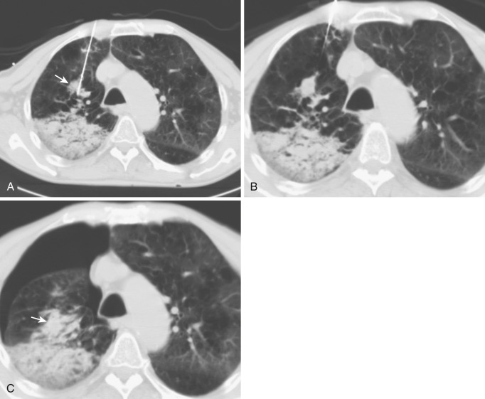 FIG 67-39, A, Patient from another hospital had a cutting needle biopsy improperly performed from two perspectives: (1) the mass (arrow) is smaller than the cutting gap of the needle, and (2) the needle is adjacent to the mass and not within. The cutting of the needle occurred in the lung and not the mass. Hemorrhage has occurred posteriorly from the initial placement. B, The biopsy was taken, which produced more bleeding posteriorly that was aspirated into the posterior bronchus. C, The lung subsequently collapsed with more bleeding around the mass (arrow) . This patient survived after emergency resuscitation.