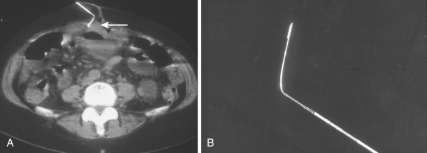 FIG 67-42, A, CT scan shows a bend in the middle of the gap (arrow) that occurred while it was in a patient. The fibrous material was so hard it bent the needle. B, CT scan shows the bent needle after it was extracted.