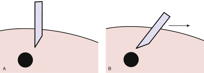 FIG 67-44, A, Diagram shows a schematic where the needle is not accurately positioned adjacent to the mass. B, Diagram shows how, by using the bevel of the needle, it can be redirected toward the mass by pulling the skin away from the point and pushing the needle slowly.