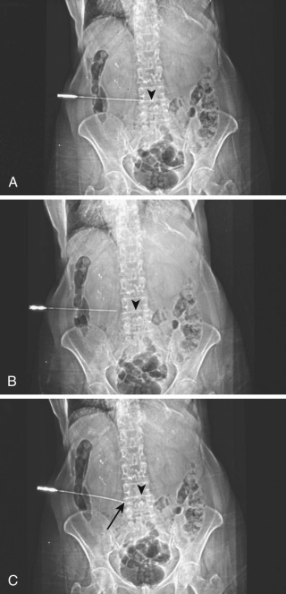 FIG 67-45, Three radiographs show the position of a needle tip (arrowheads) that is moved by the deflection method (see text). A, The needle tip is adjacent to the lower end plate of the L4 body. B, The needle has been retracted back slightly before the deflection maneuver. The skin was retracted and the bevel rotated cephalad, and the needle was pushed forward. C, The needle tip (arrow) was deflected caudad almost 10 mm to the top of the L5 end plate.