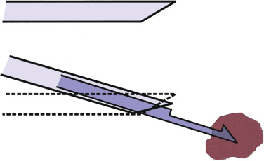 FIG 67-46, Diagram shows the same result of deflecting the needle tip with a side cutting needle. By pushing the needle at an angle and then slowly pushing out the stylet, the bevel of the stylet can direct the needle into a mass when there is a slight trajectory error.