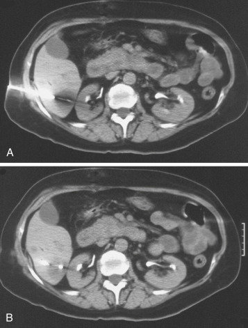 FIG 67-48, A, CT scan through the liver shows the gap of the needle faintly visible in the lesion. B, By rotating the needle, the gap is turned so that the cutting edge is toward the mass. There is a greater probability that an adequate sample will be obtained.