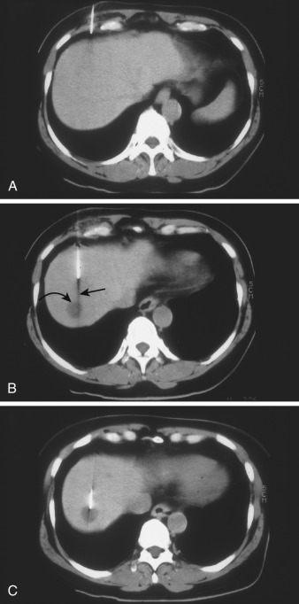 FIG 67-49, A, An entrance site below the mass is chosen so that the needle is introduced below the diaphragmatic insertions. The XY angle is approximated, and the needle is inserted partially. B, Higher CT scan at the level of the cyst (curved arrow) shows that the trajectory of the needle (straight arrow) is slightly too medial for puncture. The needle was withdrawn slightly and the bevel rotated, as shown in later scans, so that the point is directed laterally and the needle is pushed slowly to facilitate the subtle bending. C, Final CT scan shows the needle centrally in the cyst. Fluid confirmed the simple nature of the cyst.