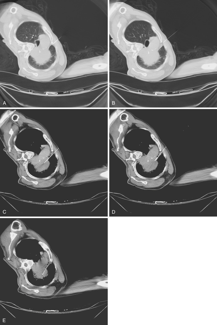 FIG 67-51, A, CT scan taken during a biopsy of a middle mediastinal mass in the area of the aorticopulmonary window. The trajectory chosen to reach the mass is through the anterior junction line but is difficult because of the narrow pathway. B, Injection of saline at the site moves the pleura 7 to 8 mm laterally. This widened pathway permits passage of a needle. C, Chiba aspiration biopsy needle was passed through the parasternal path into the mediastinal mass. The lung parenchyma was totally avoided. D, The same pathway was used for passage of a cutting needle. The needle is seen before insertion of the cutting stylet. E, The stylet is inserted with the bevel turned toward the mass so that the stylet deflects laterally away from the margin of the aorta.