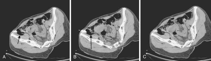 FIG 67-52, A, CT scan shows a tumor (T) in the right lower quadrant. The needle (arrow) is inserted adjacent to the bowel, which is to be moved. B, Air (10-15 cc) is injected quickly to push the bowel away. The gas with the needle is noted adjacent to the bowel (arrow). The metal needle shaft is not well seen because of the partial volume of air with the metal needle. C, With the bowel moved away, the needle could be inserted into the mass.