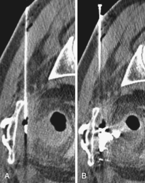 FIG 67-7, A, Patient with presacral fluid collection after surgery and radiation. The cavity has a subtle channel adjacent to the rectum, suggesting communication. Diagnostic needle aspiration was performed for culture and delineation of fistula tract by contrast injection. B, Patient was rolled slightly to enhance the flow of contrast material into any existing path. Note the contrast material entering the margin of the rectum.