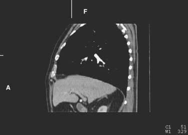 FIG 67-53, Sagittal CT scan close to the central chest shows the relationship of the ribs. Anteriorly there is fusion of several costal cartilages. The ribs are much closer posteriorly than anteriorly. In addition, the narrowing of the ribs as they approach the apex shows how the interspaces become more narrow owing to the close proximity of the ribs.