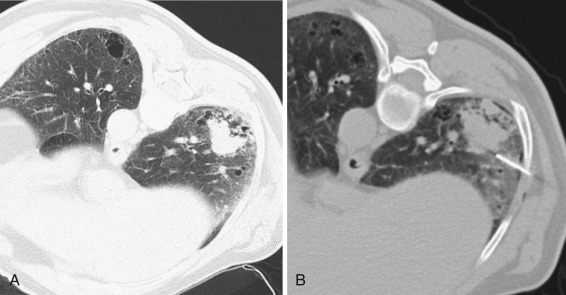 FIG 67-55, A, CT scan shows a mass adjacent to the costophrenic angle of the right lung, slightly above the diaphragm, making it very mobile with respiration. Note the many small cysts behind the mass. B, The patient is in the oblique position to immobilize the diaphragm and mass partially. The needle was inserted laterally to avoid the cysts, which might cause a pneumothorax.