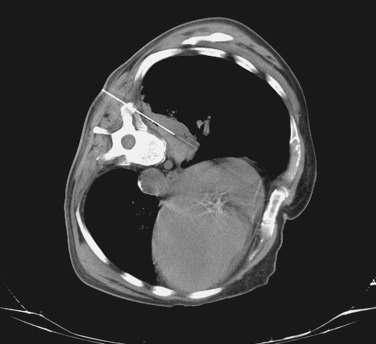 FIG 67-56, Mass in the posterior paraspinal region can be approached without traversing the lung parenchyma.