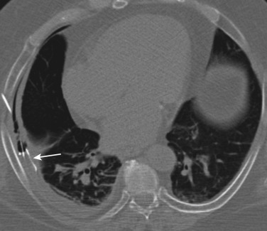 FIG 67-57, CT scan showing biopsy of a pleural-based mass. Rather than a straight approach, an oblique longer path was chosen, which increases the chance of positive results (see text). Arrow shows the “gap” of cutting needle.