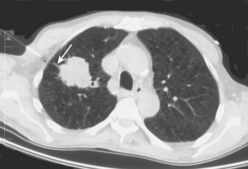 FIG 67-58, CT scan shows the approach of a mass in the right apex. The needle is positioned to traverse the “fibrous band” (arrow) while traversing to the pleura. This approach minimizes the possibility of a pneumothorax.