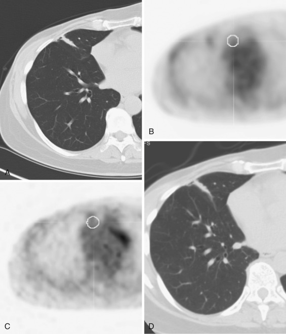 FIG 67-60, A, CT scan of a patient with a history of breast cancer shows a linear density in the right middle lobe anteriorly, which was a new finding suggestive of recurrence. B, PET scan shows increased uptake in the mass, suggestive of tumor. SUV was higher than the mediastinum. C, Repeat PET scan after an oral dose of OTC pseudoephedrine shows absence of uptake. (Oral phenylephrine 10 mg may also be used.) Our theory is that the inflammatory vessels constricted and changed the uptake of FDG. D, Repeat CT scan on same day as the second PET scan shows that the lesion looks unchanged, confirming that the changes in the PET were not due to resolution of the lesion.