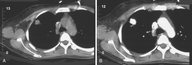 FIG 67-62, A, This small lesion was being considered for a cutting needle technique because of the close proximity to the pleura. B, Bolus scan shows enhancement of an AVM.