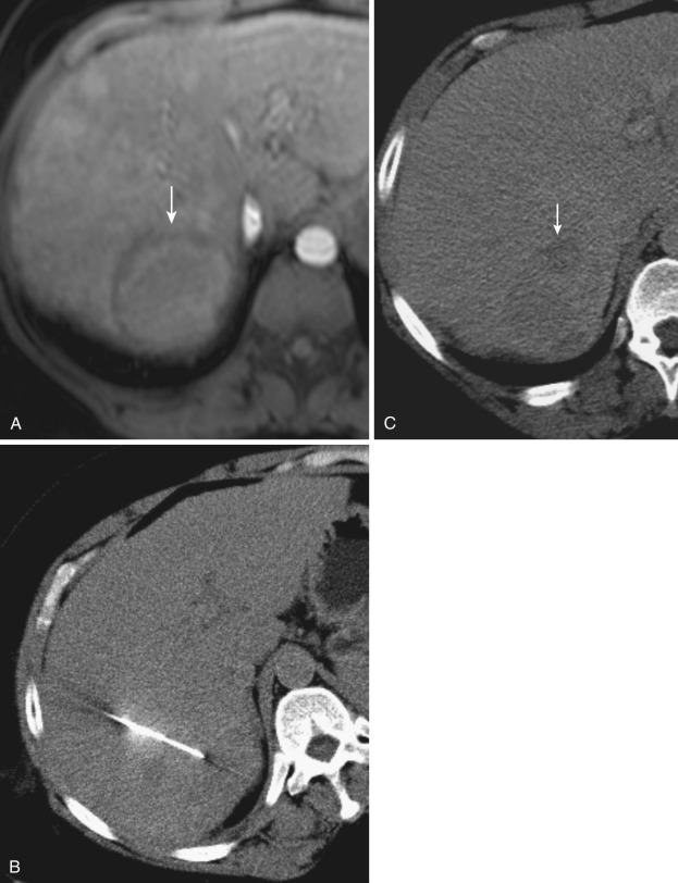 FIG 67-8, A, MRI with contrast material shows mass in medial right lobe segment 7 (arrow), with slightly increased signal and rim of edema suspicious for tumor. B, CT scan shows a very subtle lesion difficult to see clearly. Using landmarks, the site was localized. C, Biopsy of the subtle tumor mass (arrow) yielded hepatocellular carcinoma.