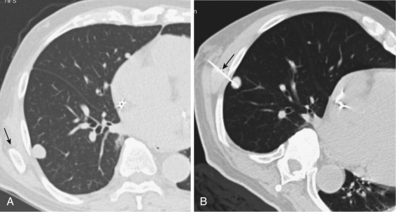 FIG 67-63, A, A patient with a small posterior lateral mass is positioned so that the rib and scapula block a potential pathway to the lesion (arrow). B, When the patient was placed in the left posterior oblique position, the anatomy shifted so that biopsy could be performed (arrow). If a more anterior or posterior approach were taken, a pneumothorax would have been more likely because of the length of lung traversed.