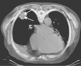 FIG 67-64, Biopsy of pleural-based masses can be easily and safely accomplished with cutting needles if the gap of the needle is confined to the mass (arrows). Note the thin fat line of retracted pleura adjacent to the mass, indicating adherence.