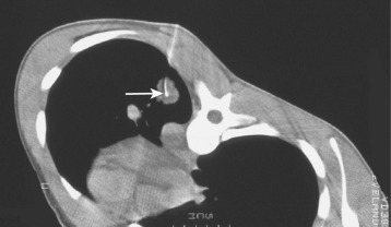 FIG 67-65, Scan of a cutting needle biopsy of a granuloma. Note the bend (arrow) in the needle produced by the hard character of the mass.