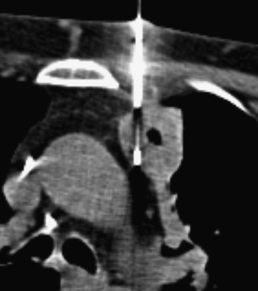 FIG 67-66, CT scan shows a necrotic mass in the anterior mediastinum. A biopsy is taken of the wall and may include some of the necrotic material.