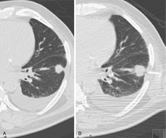 FIG 67-67, A, Small lateral mass close to the pleura with a linear band connecting to the pleura. The patient had platelet inhibitor therapy, which could not be stopped, so a low infusion of platelets was performed. We use this method if a mass is adjacent to the pleura but are reluctant to do so if the mass is deeper. B, Biopsy was performed laterally through the fibrous band.