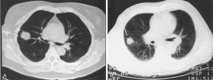 FIG 67-68, Difference in approach for two lesions that are almost identical. A, This CT scan shows a direct lateral approach, with the distance of lung being crossed almost half of that in B . B, This biopsy approach traverses almost twice the distance of lung and increases the potential risk by a factor of almost 3 according to new data (see text).