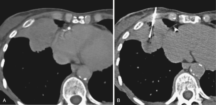 FIG 67-69, A, A large mass in the anterior right middle lobe. Note the collapsed lung peripherally and the bulging mass centrally, similar to the “golden S sign” described for plain radiographs. B, Biopsy through the collapsed lung was performed. Because there is no aerated lung, the change of pneumothorax is minimal.