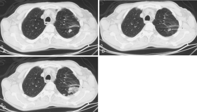 FIG 67-70, These three scans show the optimal approach for performing a biopsy. A, CT scan shows the needle positioned adjacent to the pleura, not the bulging of the pleura produced by the injection of lidocaine. B, The needle was advanced into the lesion for the biopsy. C, CT scan after removal of the needle shows a small infiltrate in the lung, representing hemorrhage. Small amounts of bleeding such as this are common and are of no significance.