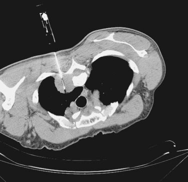 FIG 67-71, Rounded masses such as this by the neural foramina are likely to be of neurogenic origin. Lateral meningoceles yield cerebrospinal fluid on aspiration. Schwannomas such as this one yield diagnostic tissue when sampled by cutting needle, as noted here, but are painful during biopsy because they are attached to the nerve roots.