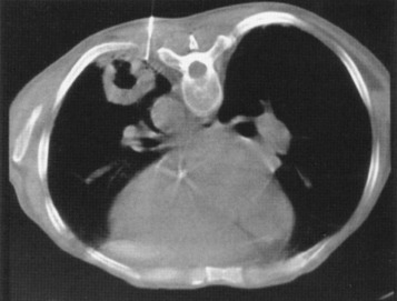 FIG 67-72, CT scan shows biopsy of a large cavitated nodule. The periphery of the mass is targeted for best results. Some authors have suggested that in such cases a higher incidence of pneumothorax and hemorrhage exists. A pathway through the thickened pleura was chosen to minimize pneumothorax.