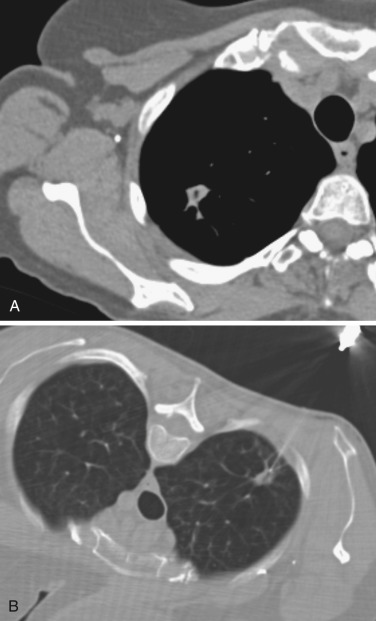 FIG 67-9, A, CT scan shows a small mass posteriorly in the right upper lobe. With the patient supine, there is no pathway clear of intervening structures such as the ribs and scapula. An approach through the axilla is not possible because of the axillary artery and vein, which are anterior to the small metal suture. B, The patient was repositioned in an anterior oblique position, which permits needle insertion through a clear pathway posteriorly.