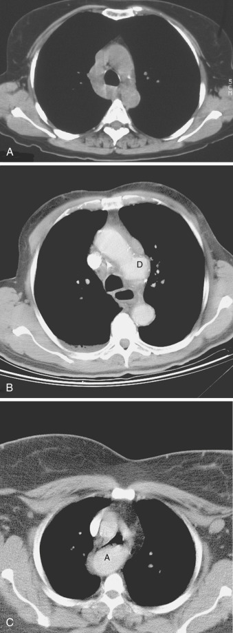 FIG 67-73, Common vascular variations are noted in these three images, which should not be mistaken for tumors; distinction is easy with contrast material. A, CT scan shows a very prominent azygos vein. B, CT scan at the level of the aortic arch shows a small aneurysm at the ductus region (D). C, CT scan of the upper mediastinum shows an enhancing mass behind the trachea, which represents an aberrant subclavian artery.