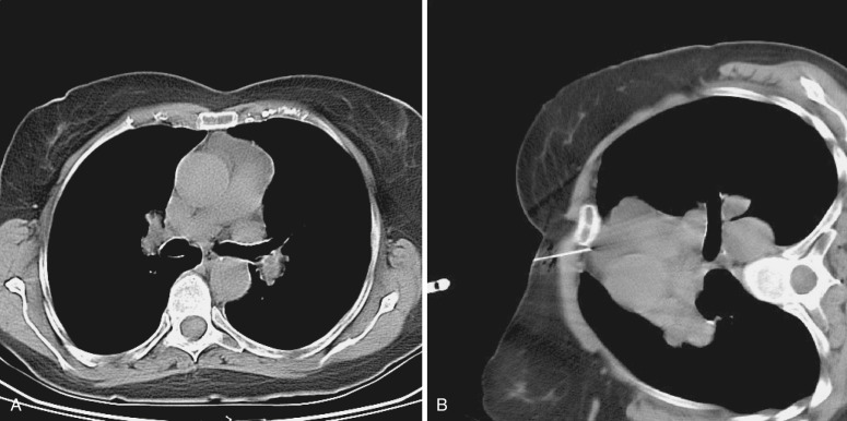 FIG 67-75, A, CT scan shows an ill-defined mass in the anterior mediastinum, believed to be a subtle mass in the thymus. With the patient in the supine position, access to the mass cannot be obtained without crossing the lung. B, When the patient is positioned on the side, the mediastinal structures shift, permitting access for needle placement into the mediastinum.