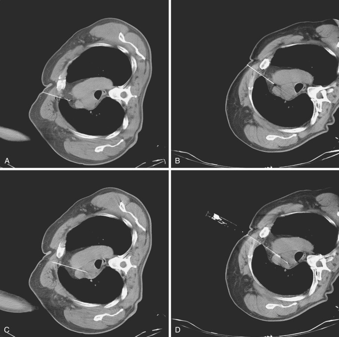 FIG 67-77, A, A mass located in the azygos region shows tumor posterior to the cava and aorta. Initial positioning of needle required slight medial direction. B, A Chiba needle within the coaxial cannula is pushed past the vessels, with the bevel directed toward the vena cava. C, Through the cannula, Chiba needle aspiration was performed. D, After removal of Chiba needle, a cutting needle (20-gauge) procedure was performed. We have called this the coaxial slide method.