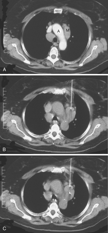 FIG 67-79, A, CT scan during bolus injection shows enhancement of the aortic arch (A). The mass (M) in the aorticopulmonary window of the middle mediastinum is clearly seen. B, Because the anterior juncture is wide, insertion of a Chiba needle is simple. C, With precise visualization of the margins of a cutting needle, accurate placement of the gap and sampling of the mass are easily accomplished. Because the action of the needle is confined to the gap, there is no risk of damage to the aorta.