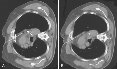 FIG 67-80, A, Access for this biopsy was not present when the patient was lying supine (see Fig. 67-10 ). The mediastinum shifted, opening up access through the anterior fat (bidirectional arrows). The path of the needle was not appropriate for sampling a small lymph node (arrow). B, The needle was redirected using the deflection method described and shown earlier. The node was sampled without removal of the needle and redirection.