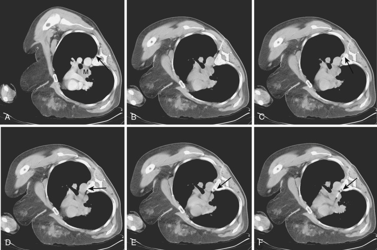 FIG 67-81, A, Middle mediastinum shows a mass (M) clearly distinguished from the opacified vessels (arrow) . The method shown here is effective for consistently sampling such masses. B, The needle is inserted at a point where the trajectory crosses the junction between the transverse process and the rib. Saline is injected into the paraspinal tissues, moving the pleura more laterally, facilitating easy passage of the needle. C, CT scan shows the next step in the procedure, which consists of positioning the needle against the anterolateral margin of the vertebral body (arrow) . The bevel of the needle is directed toward the body; the needle is pushed forward close to the aorta. D, When the needle is against the aorta, the bevel is turned toward the aorta and pushed forward past the aorta (arrow) . E, At this point the bevel of the needle is turned toward the azygos vein and pushed forward (arrow). F, Final positioning of the needle is within the mass (arrow) .