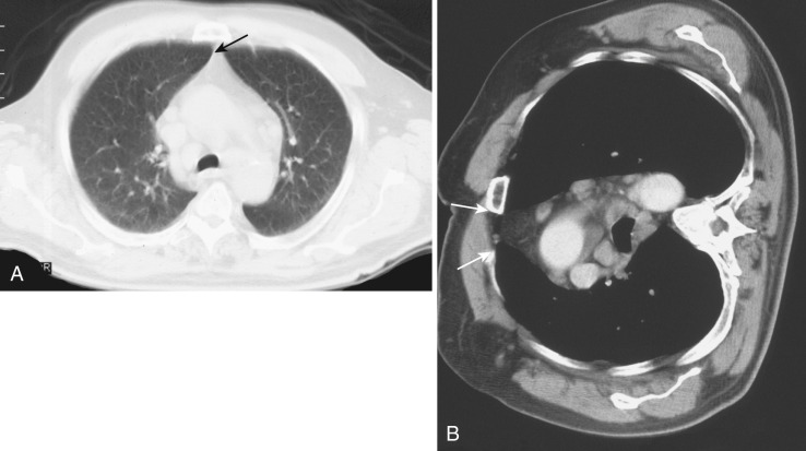 FIG 67-10, A, CT scan shows a subtle mass in the anterior mediastinum (arrow), thought to be thymus, but the clinical situation dictated that a biopsy be performed. The anterior junction line is concealed behind the sternum. The only possible biopsy approach would be a very lateral one traversing much lung parenchyma. B, With the patient lying on the right side, the mediastinum shifted so that a clear access to the mass without crossing the lung was provided (arrows) .