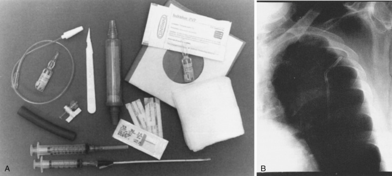 FIG 67-84, A, Disposable chest tube trays such as this are available. These are complete and provide all necessary equipment, including the instruments, tube, and Heimlich valve. B, This chest film shows the chest tube in the left upper lobe. Whenever the tube is positioned, one should clinically check for the egress of air to ensure proper function.