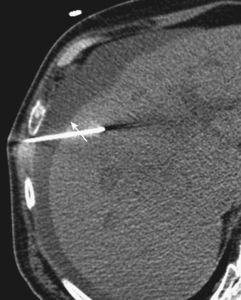 FIG 67-86, CT-guided biopsy of the liver with the presence of ascites (arrow). The presence of ascites is not a contraindication to biopsy (see text). In the series by Murphy and colleagues, patients with ascites had lower bleeding rates as long as the coagulation laboratory values were normal. 370