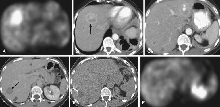 FIG 67-87, This patient with breast cancer had coexisting masses in the liver, some of which were FDG positive and one that was not. A, PET study shows an FDG hot spot in the anterior right lobe of the liver. B, CT scan of the same area shows a low-density mass with tumor in the anterior right lobe (arrow). C, CT scan shows a small lesion in the posterior right lobe, which grew and was biopsied. D, Repeat CT scan shows that the lesion (arrow) has grown. E, CT-guided biopsy of site is positive for cancer. New information in the cancer literature indicates that tumors can change their metabolism to self-consumption of proteins, called autophagy, and not burn glucose, being negative on FDG PET. F, PET scan performed before biopsy shows negative uptake in the area of the liver that was biopsied.