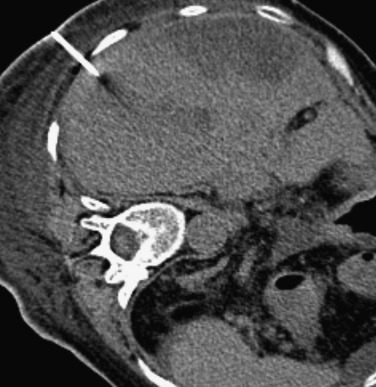 FIG 67-89, Avoidance of the diaphragm is the most reasonable approach. This patient was positioned in the left posterior oblique position, which exaggerated the visibility of the pleural space. No pleural space was noted, but the needle path was close to the midaxillary line, which minimizes the probability of traversing the pleura based on the fact that the diaphragm inserts higher anteriorly than posteriorly (see Fig. 67-53 ).