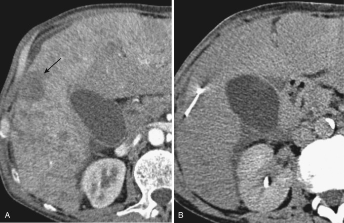 FIG 67-90, A, Bolus CT scan of the liver before biopsy. Note enhancement of the vessels and visualization of the medium-sized portal vein anteriorly (arrow). B, The needle trajectory avoided the site of the vessel, preventing possible damage.